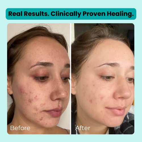 Hydrocolloid Roll - Healing Technology